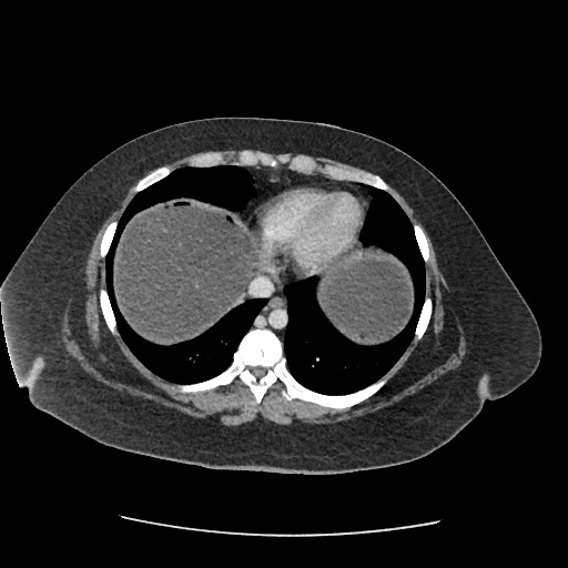 File:Bowel and splenic infarcts in acute lymphocytic leukemia (Radiopaedia 61055-68915 A 17).jpg