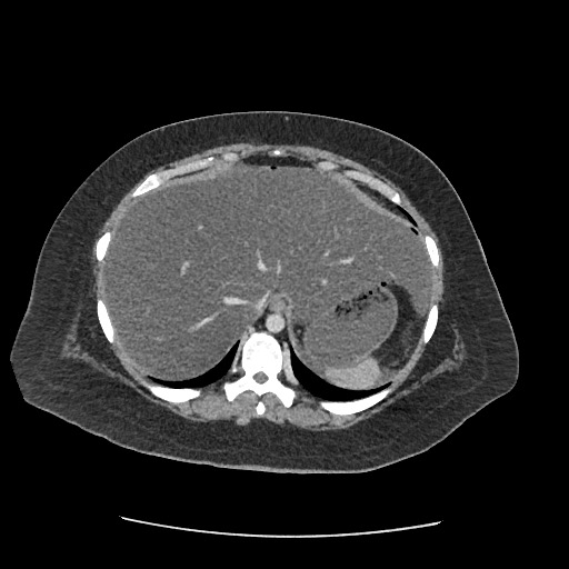 Bowel and splenic infarcts in acute lymphocytic leukemia (Radiopaedia 61055-68915 A 26).jpg