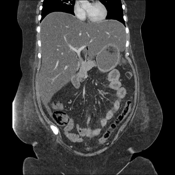 File:Bowel and splenic infarcts in acute lymphocytic leukemia (Radiopaedia 61055-68915 B 27).jpg