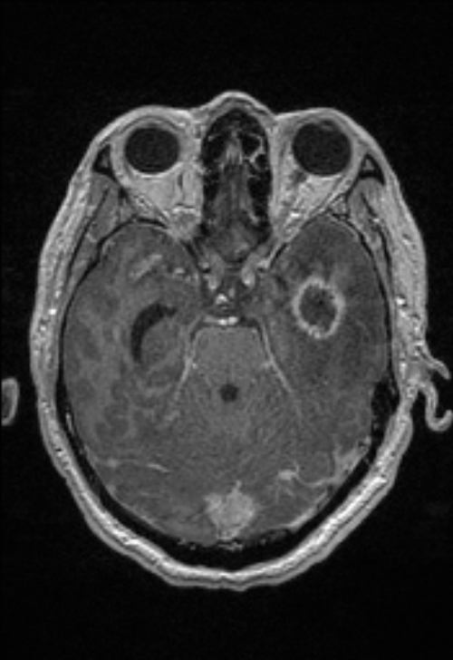 Brain abscess with ventriculitis (Radiopaedia 85703-101495 Axial T1 C+ 66).jpg