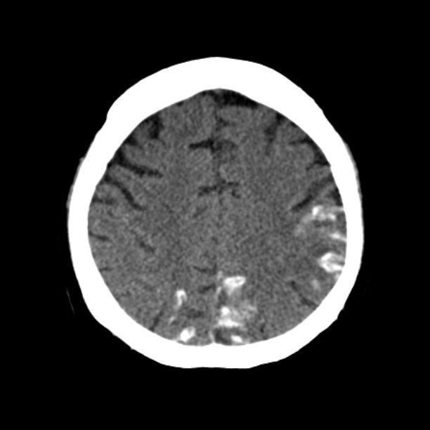 Brain cortical laminar necrosis (Radiopaedia 25822-25971 Axial non-contrast 33).jpg