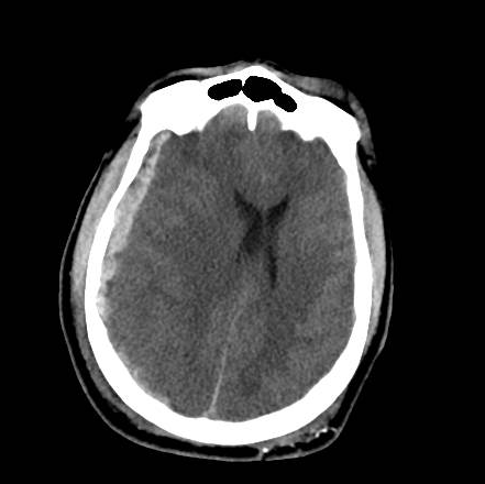 File:Brain death after motor vehicle collision (Radiopaedia 88470-105114 Axial 10).png
