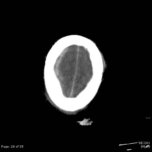 File:Brain death after motor vehicle collision (Radiopaedia 88470-105114 Axial non-contrast 28).jpg