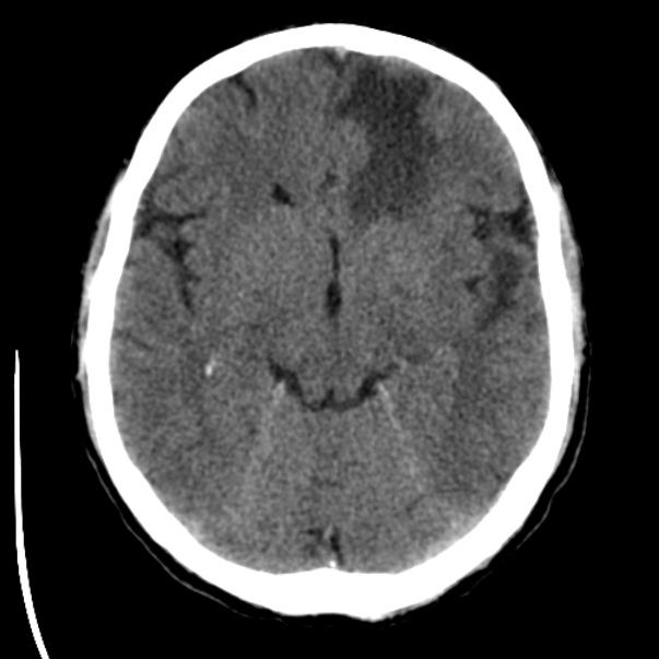 Brain metastases from lung cancer (Radiopaedia 24480-24781 Axial non-contrast 19).jpg