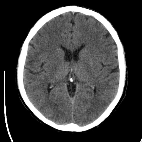 Brain metastases from lung cancer (Radiopaedia 24480-24781 Axial non-contrast 26).jpg