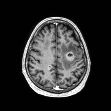 File:Brain metastases from lung cancer (Radiopaedia 83839-99028 Axial T1 C+ 50).jpg