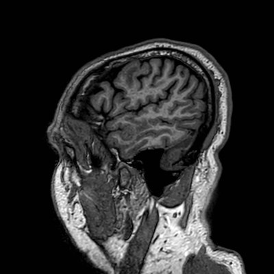 Brain metastases from lung cancer (Radiopaedia 83839-99028 Sagittal T1 113).jpg