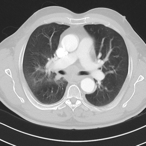 Brain metastasis (large cystic mass) (Radiopaedia 47497-52104 Axial lung window 20).png