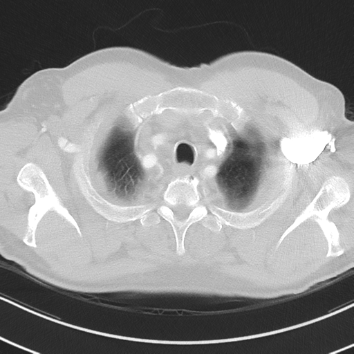 Brain metastasis (large cystic mass) (Radiopaedia 47497-52104 Axial lung window 4).png