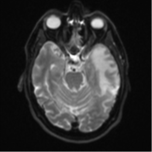 Brain metastasis (large cystic mass) (Radiopaedia 47497-52107 Axial DWI 9).png