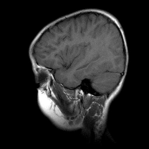 File:Brainstem ganglioglioma (Radiopaedia 10763-11224 Sagittal T1 15).jpg