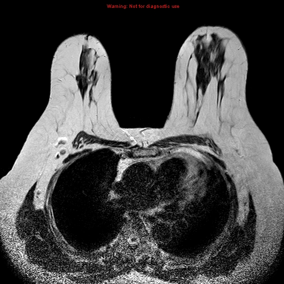 File:Breast carcinoma (multicentric multifocal in mammary Paget disease) (Radiopaedia 50966-56512 Axial T2 13).jpg
