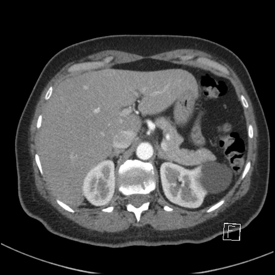 File:Breast metastases from renal cell cancer (Radiopaedia 79220-92225 A 90).jpg