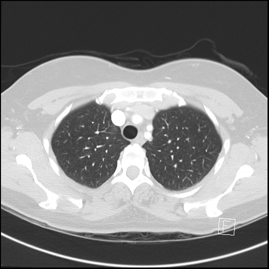 Breast metastases from renal cell cancer (Radiopaedia 79220-92225 Axial lung window 17).jpg