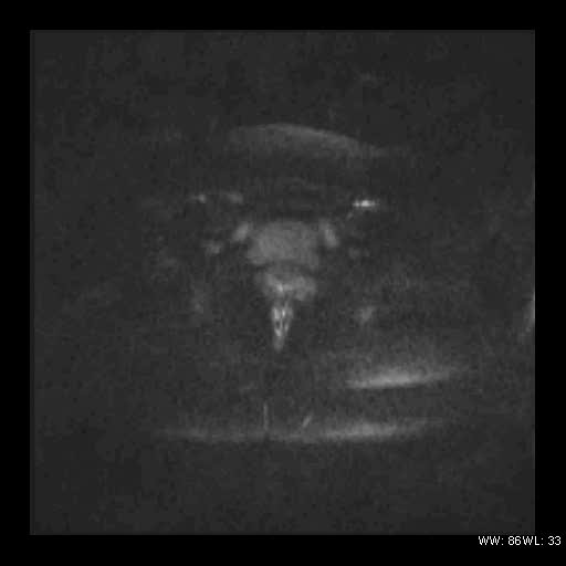 File:Broad ligament fibroid (Radiopaedia 49135-54241 Axial DWI 24).jpg