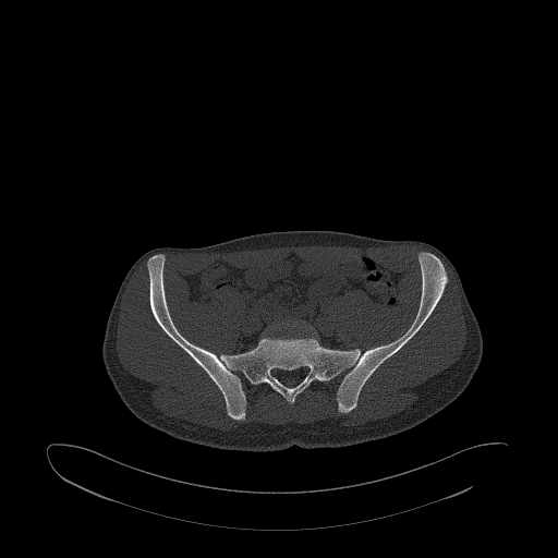 Brodie abscess- femoral neck (Radiopaedia 53862-59966 Axial bone window 35).jpg