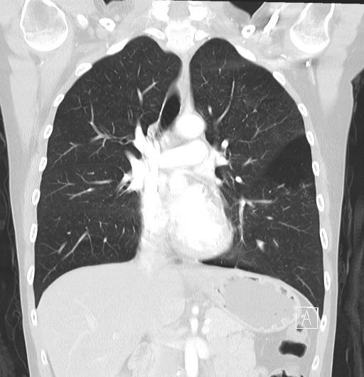 File:Bronchial atresia (Radiopaedia 73677-84470 Coronal lung window 16).jpg
