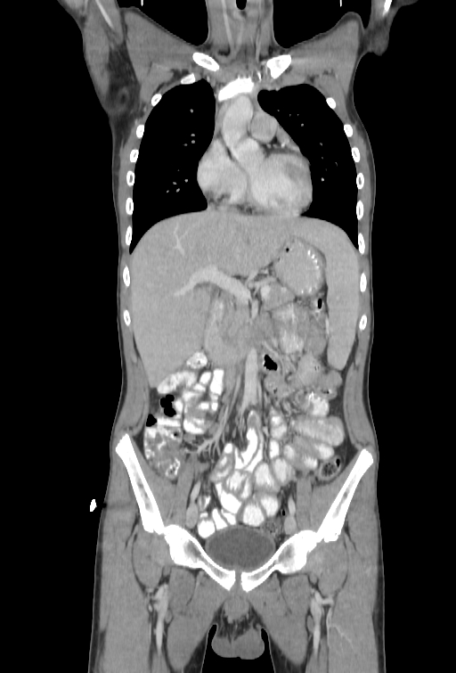 Bronchial carcinoid tumor (Radiopaedia 57187-64090 B 27).jpg