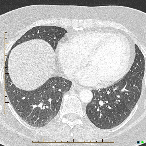 Bronchial diverticula (Radiopaedia 79512-92676 Axial lung window 143).jpg