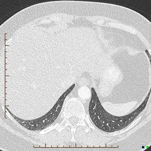 Bronchial diverticula (Radiopaedia 79512-92676 Axial lung window 180).jpg