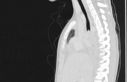 Bronchial mucoepidermoid carcinoma (Radiopaedia 57023-63895 Sagittal lung window 66).jpg