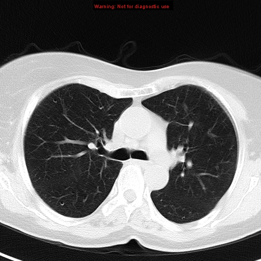 File:Bronchoalveolar carcinoma (BAC) (Radiopaedia 13436-13392 Axial lung window 20).jpg