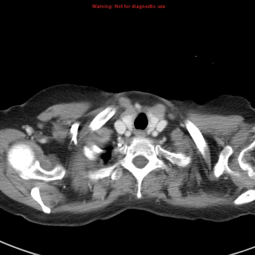 File:Bronchoalveolar carcinoma (BAC) (Radiopaedia 13436-13392 B 3).jpg