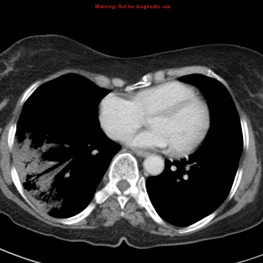 File:Bronchoalveolar carcinoma (BAC) (Radiopaedia 13436-13392 B 35).jpg
