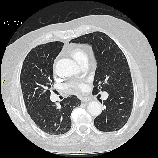 Bronchogenic carcinoma as an incidental finding (Radiopaedia 16453-16130 Axial lung window 60).jpg