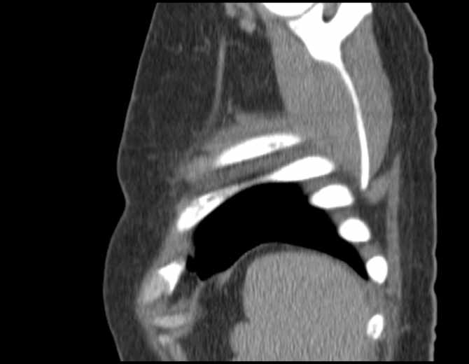 Brown tumors compressing the spinal cord (Radiopaedia 68442-77988 B 52).jpg
