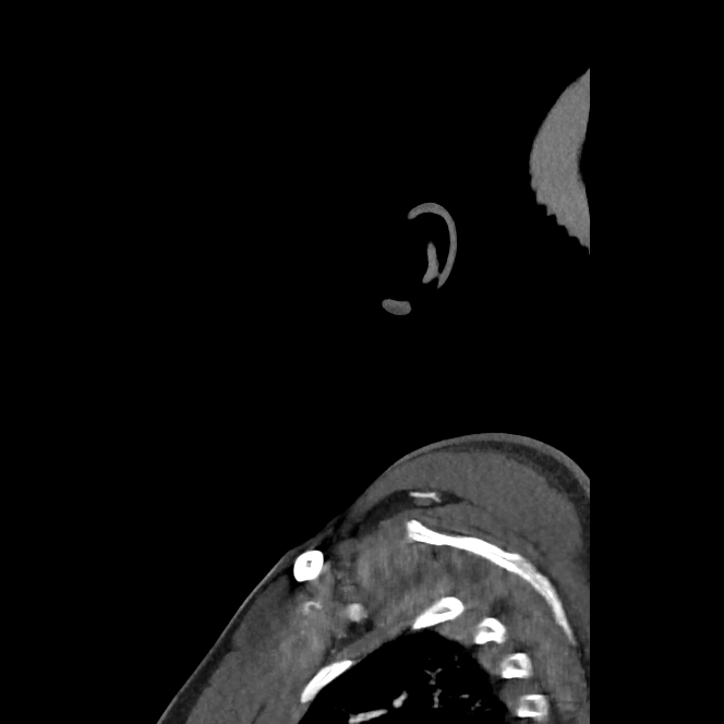 Buccal fat pad arteriovenous malformation (Radiopaedia 70936-81144 C 17).jpg
