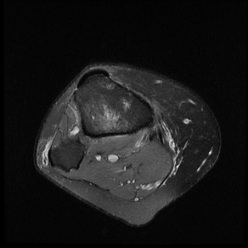 File:Bucket handle meniscus tear (Radiopaedia 56916-63751 Axial PD fat sat 20).jpg