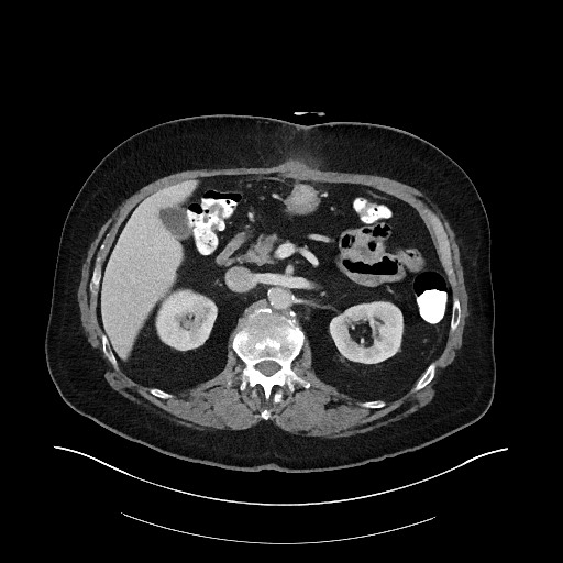 Buried bumper syndrome - gastrostomy tube (Radiopaedia 63843-72575 A 24).jpg