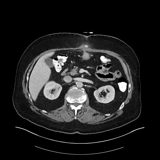Buried bumper syndrome - gastrostomy tube (Radiopaedia 63843-72575 A 25).jpg