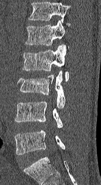 Burst fracture (Radiopaedia 53373-59357 Sagittal bone window 48).jpg