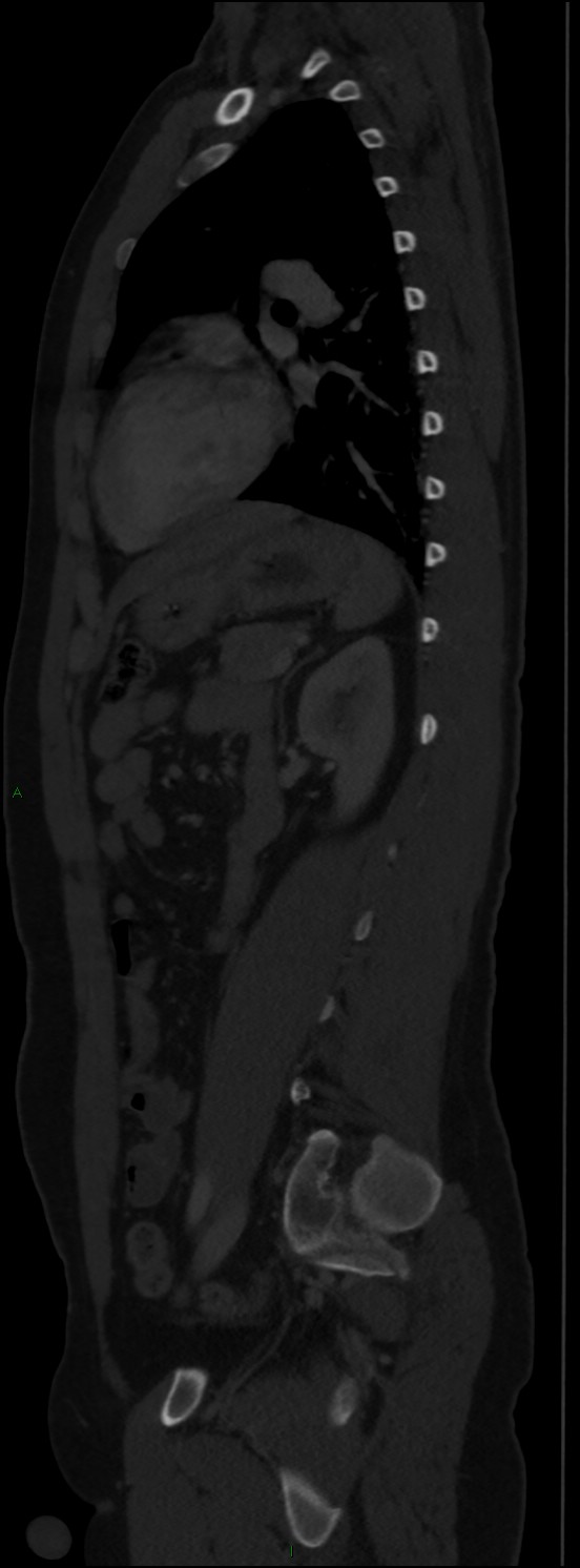 Burst fracture (Radiopaedia 83168-97542 Sagittal bone window 82).jpg