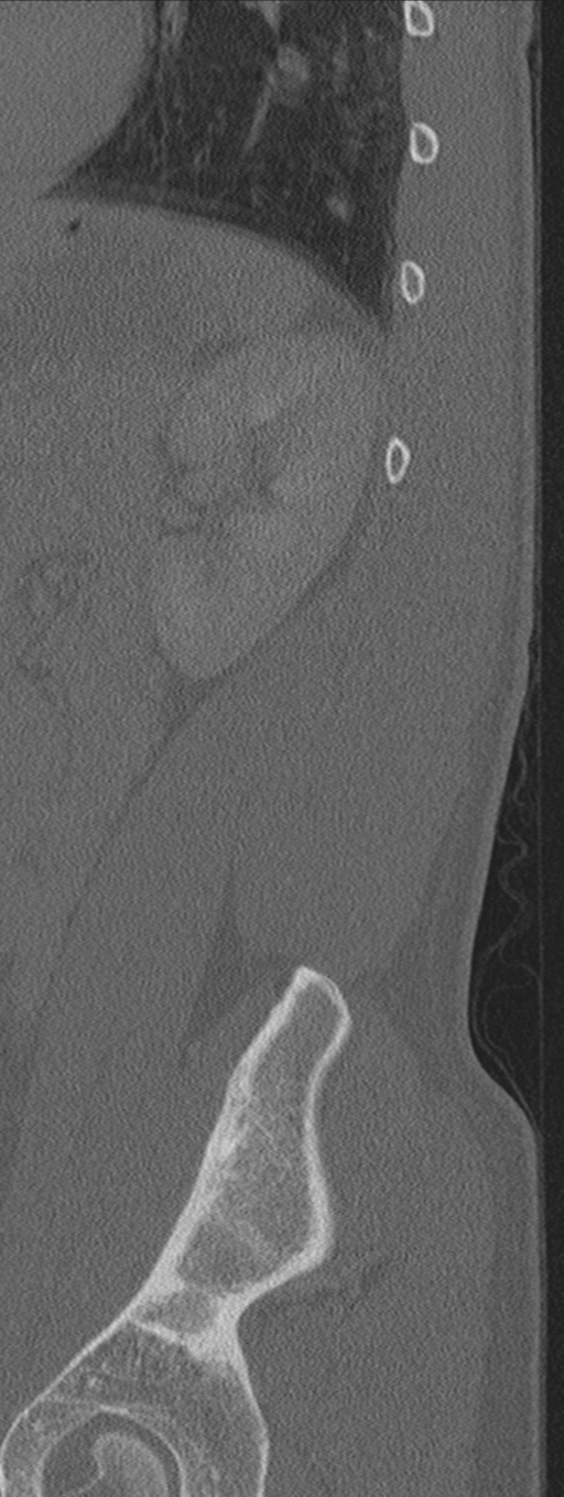 Burst fracture - T12 with conus compression (Radiopaedia 56825-63647 Sagittal bone window 5).png