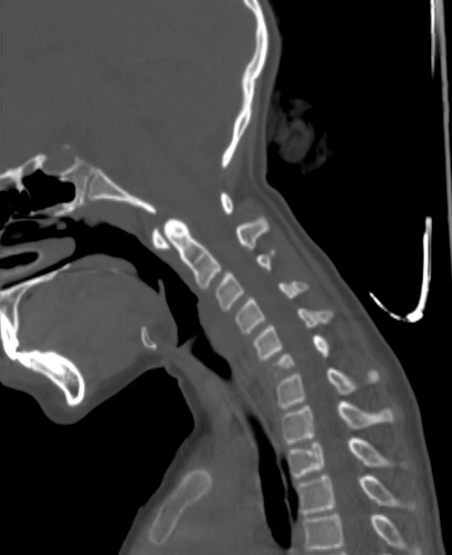 Butterfly vertebra (Radiopaedia 77903-90209 Sagittal bone window 41).jpg