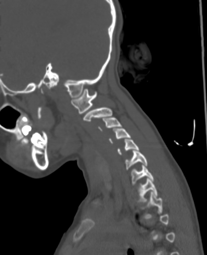 File:Butterfly vertebra (Radiopaedia 77903-90209 Sagittal bone window 82).jpg