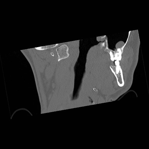 C1-C2 "subluxation" - normal cervical anatomy at maximum head rotation (Radiopaedia 42483-45607 Coronal non-contrast 6).jpg