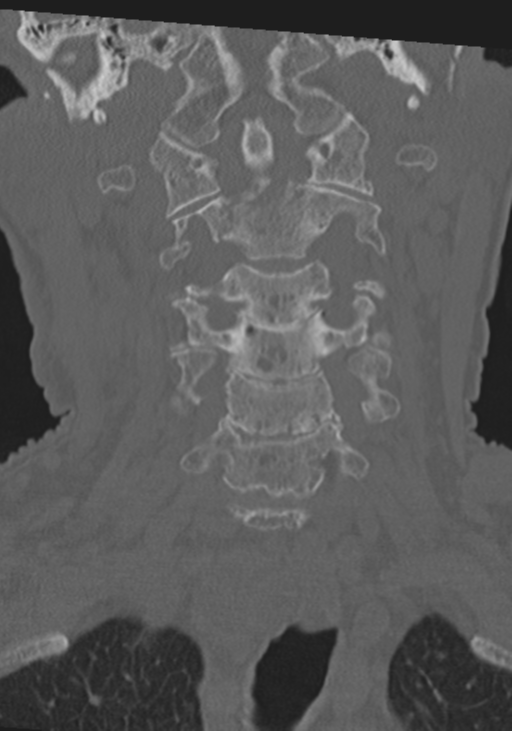 C2 fracture with vertebral artery dissection (Radiopaedia 37378-39199 Coronal bone window 15).png