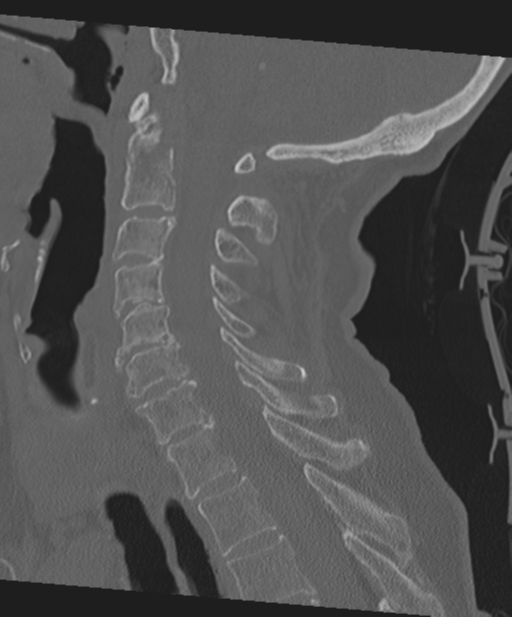 C2 fracture with vertebral artery dissection (Radiopaedia 37378-39199 Sagittal bone window 38).png