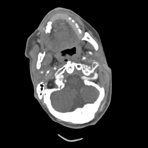 C2 fracture with vertebral artery dissection (Radiopaedia 37378-39200 A 180).png