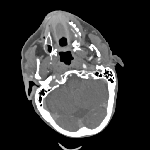 File:C2 fracture with vertebral artery dissection (Radiopaedia 37378-39200 A 197).png