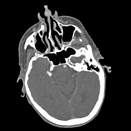 C2 fracture with vertebral artery dissection (Radiopaedia 37378-39200 A 221).png