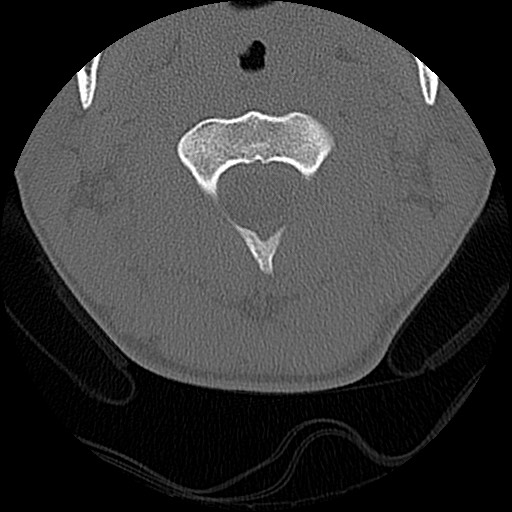 File:C5 facet fracture (Radiopaedia 58374-65499 Axial bone window 22).jpg