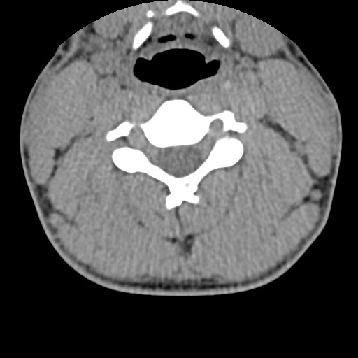 File:C5 facet fracture (Radiopaedia 58374-65499 Axial non-contrast 46).jpg