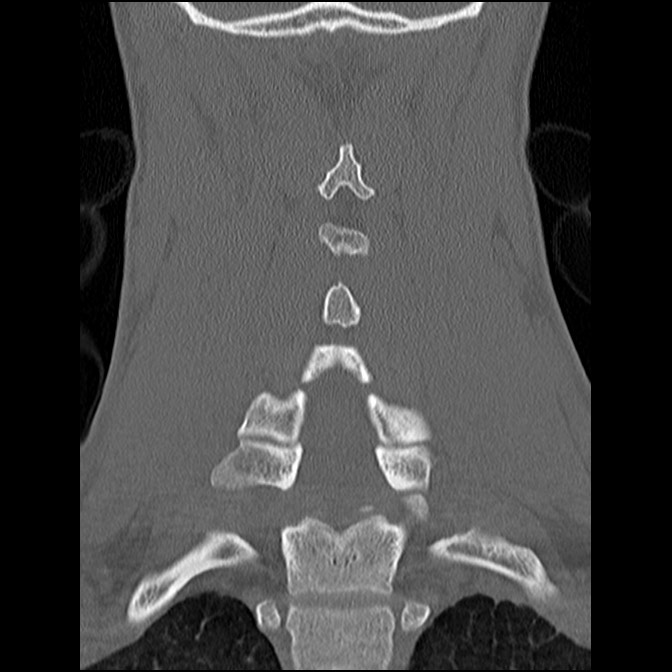 C5 facet fracture (Radiopaedia 58374-65499 Coronal bone window 39).jpg