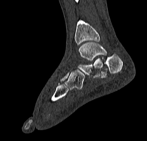 Calcaneal fracture - Sanders type 4 (Radiopaedia 90179-107370 Sagittal bone window 55).jpg