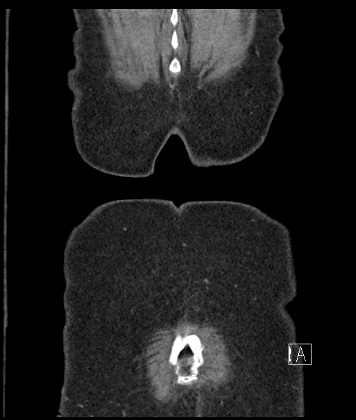 Calcified adrenal glands and Spigelian hernia (Radiopaedia 49741-54988 B 117).jpg